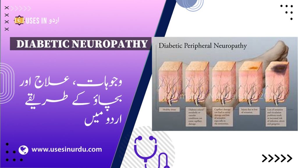 Diabetic Neuropathy