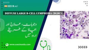 Diffuse Large B-Cell Lymphoma (DLBCL)