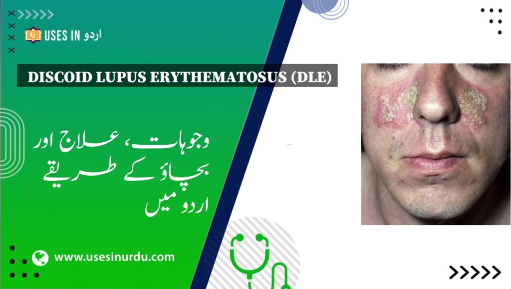 Discoid Lupus Erythematosus (DLE)