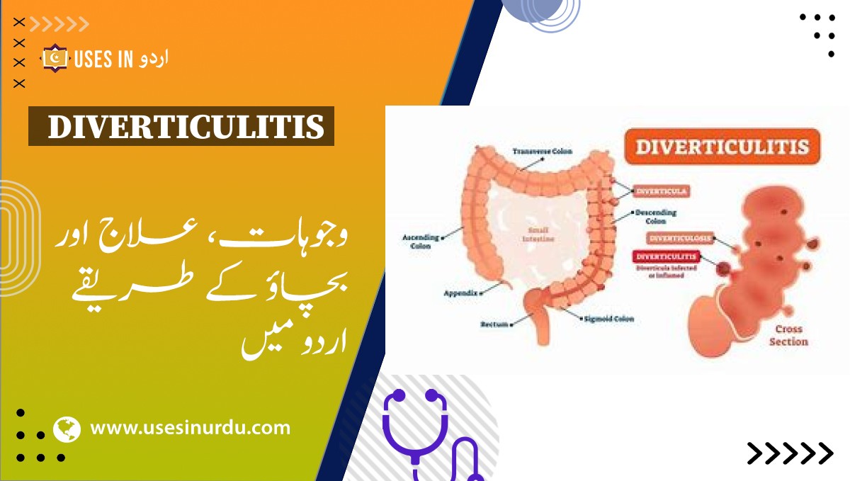 Diverticulitis