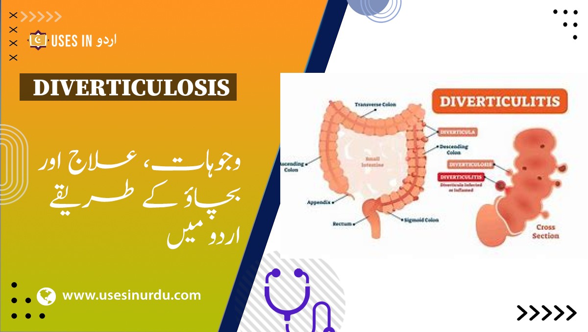 Diverticulosis