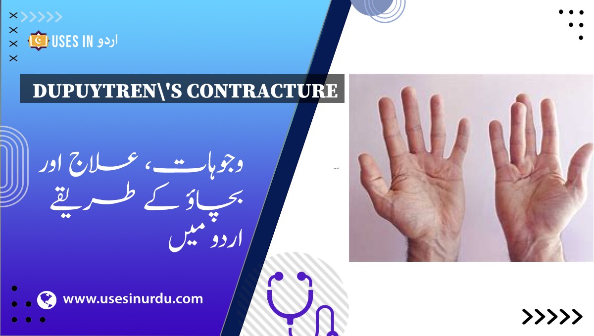 Dupuytren's Contracture