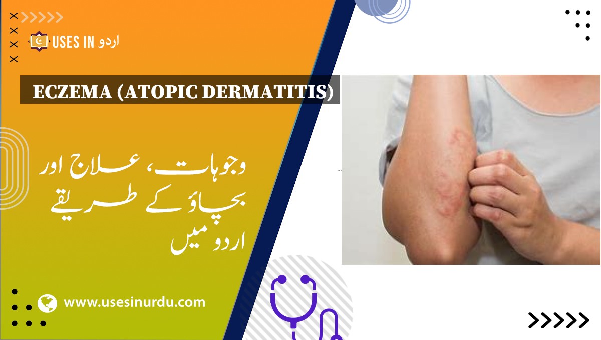 Eczema (Atopic Dermatitis)