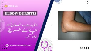 Elbow Bursitis