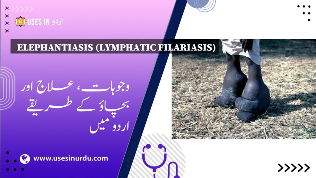 Elephantiasis (Lymphatic Filariasis)