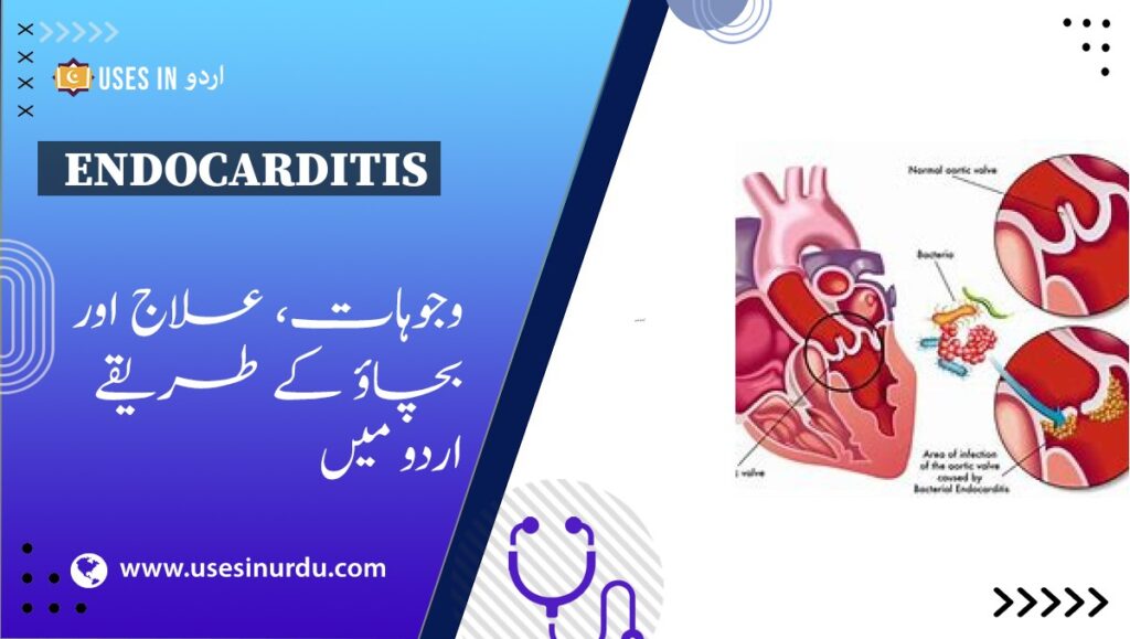 Endocarditis