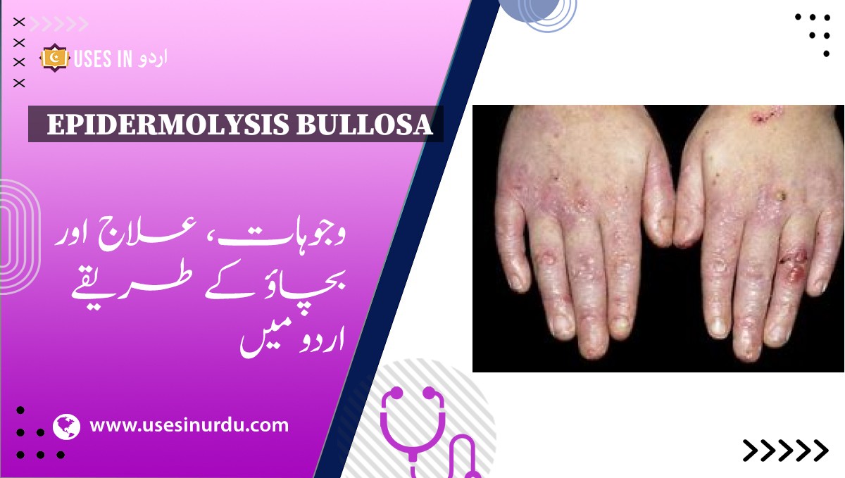 Epidermolysis Bullosa