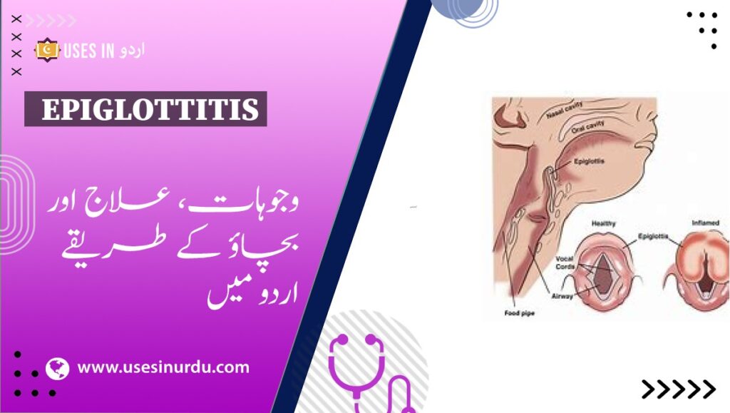 Epiglottitis