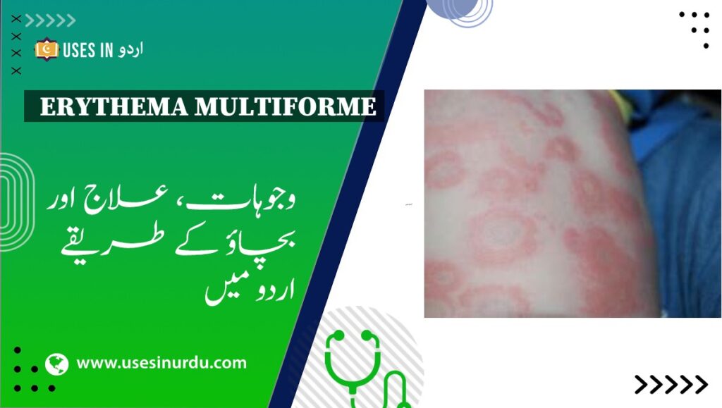 Erythema Multiforme