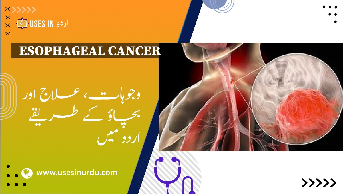 Esophageal Cancer