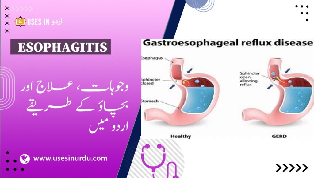 Esophagitis