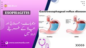 Esophagitis