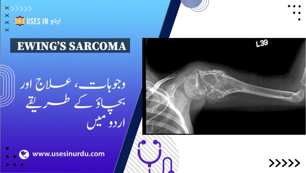 Ewing’s Sarcoma