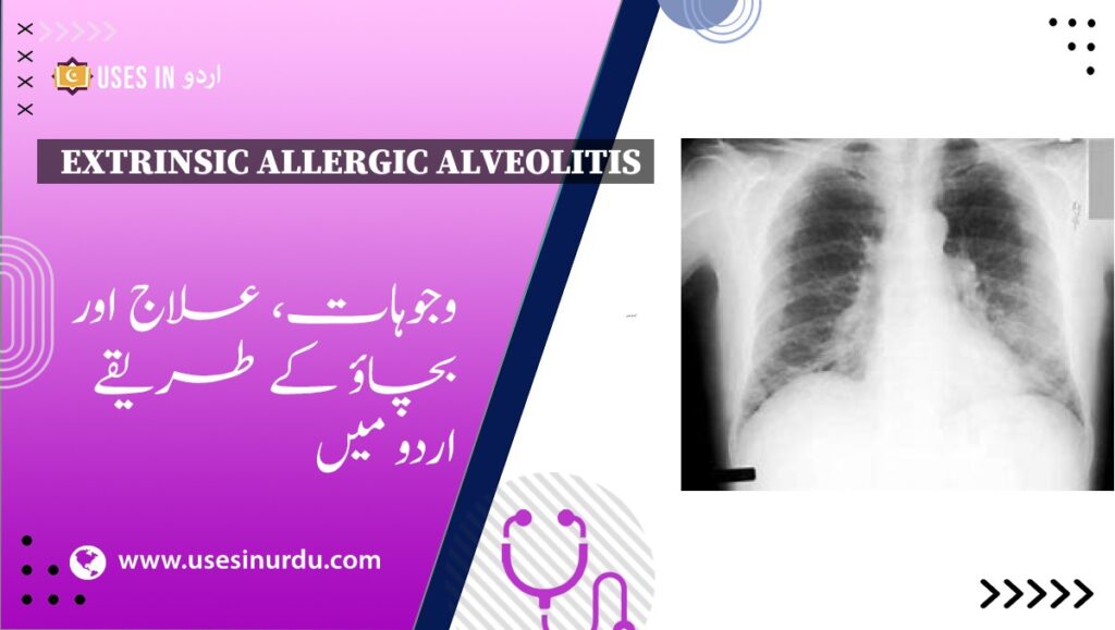 Extrinsic Allergic Alveolitis