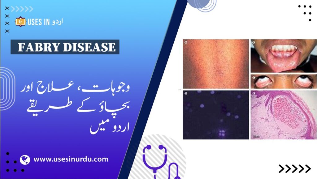 Fabry Disease