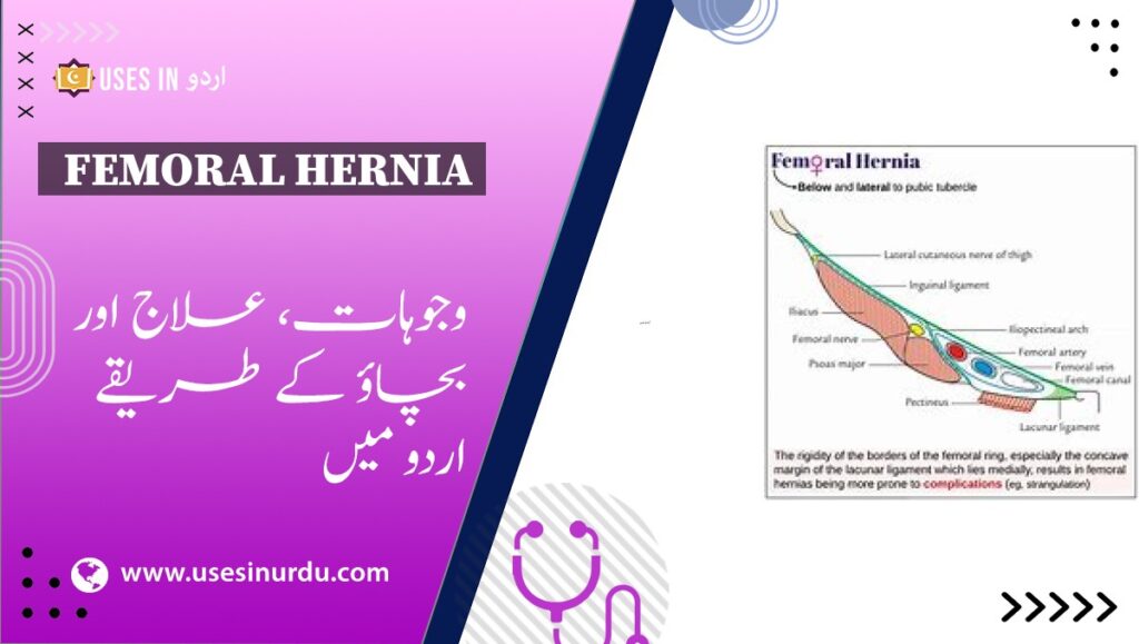 Femoral Hernia