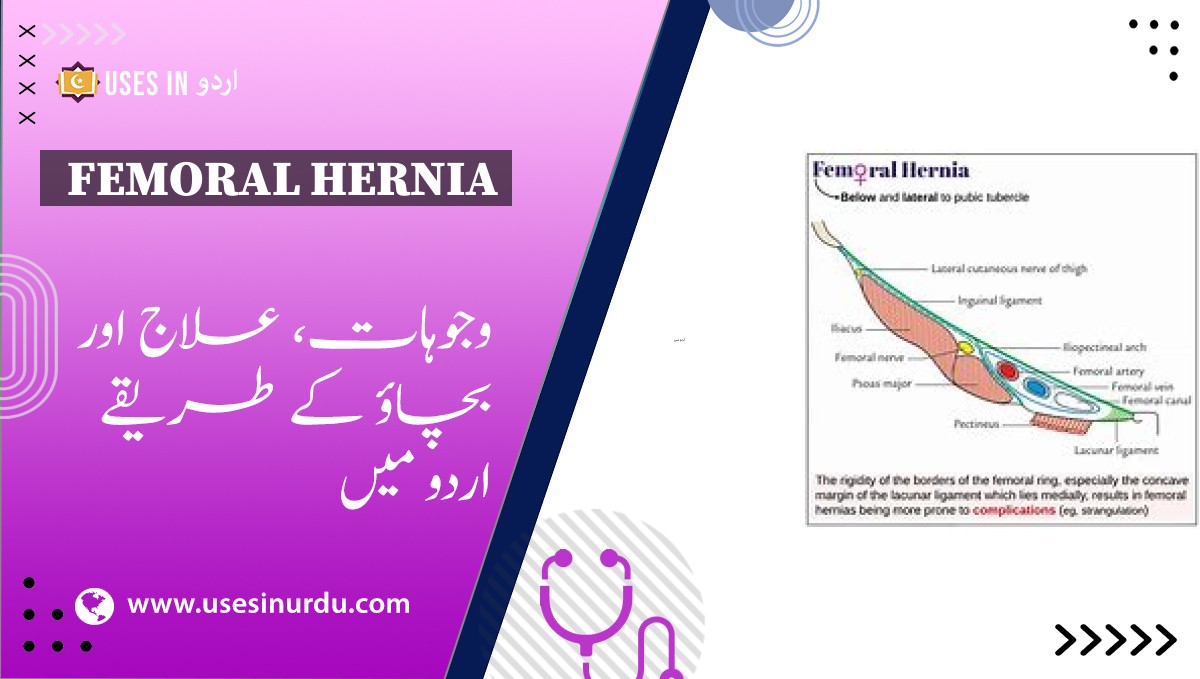 Femoral Hernia