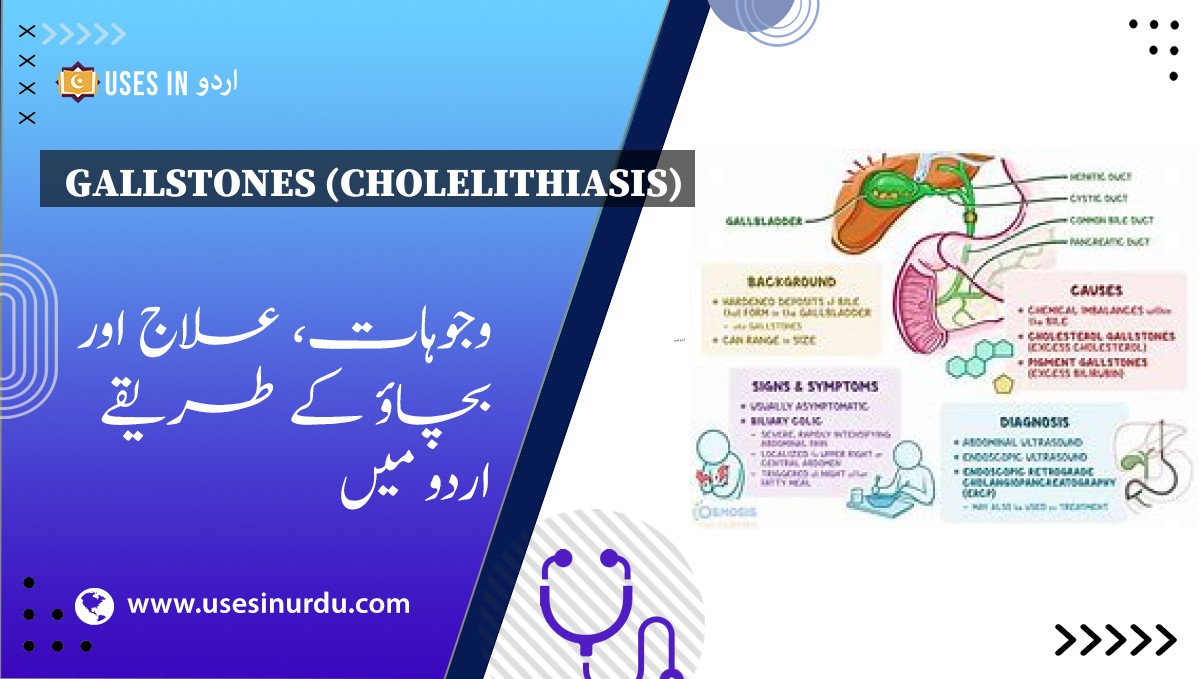 Gallstones (Cholelithiasis)