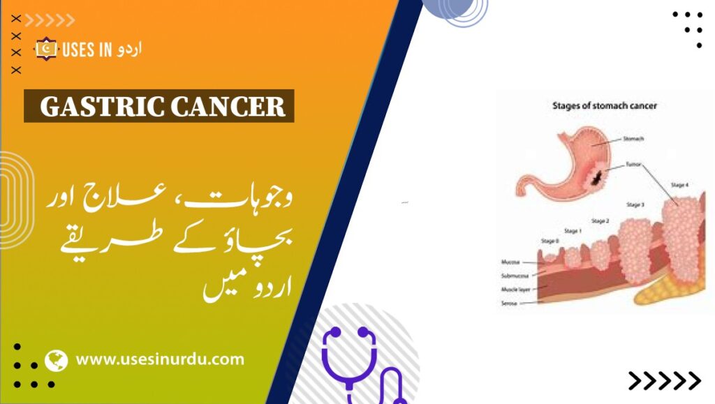 Gastric Cancer