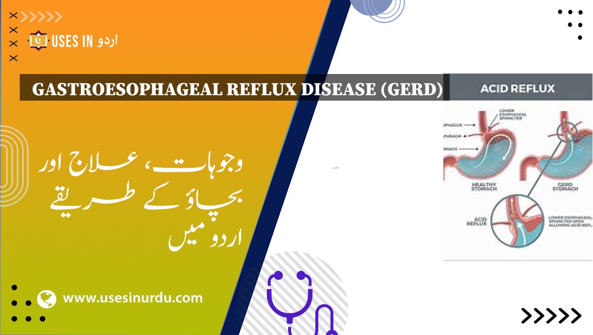 Gastroesophageal Reflux Disease (GERD)