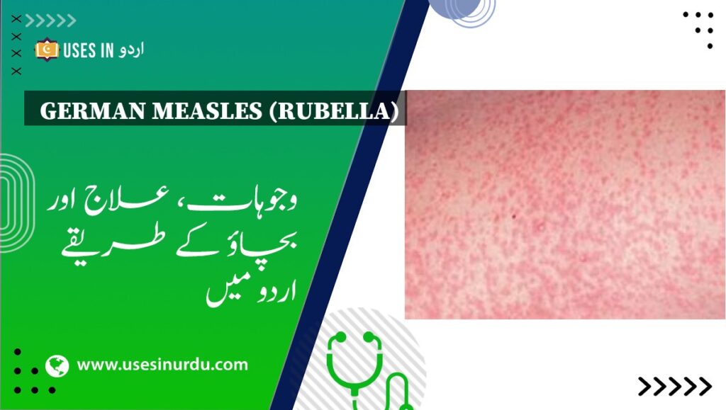 German Measles (Rubella)