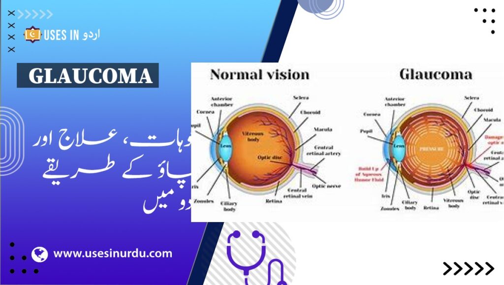 Glaucoma