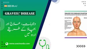 Graves' Disease
