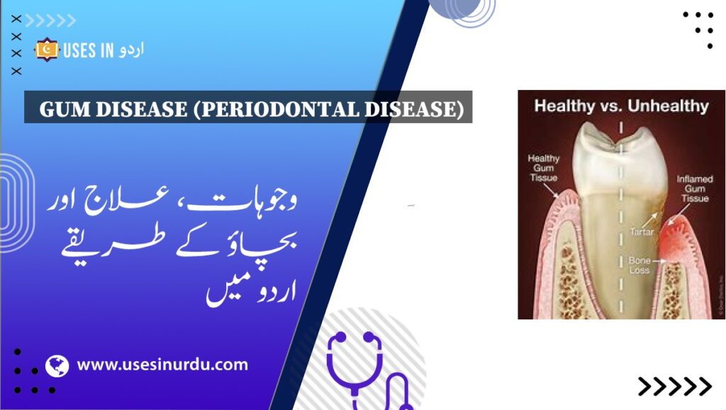 Gum Disease (Periodontal Disease)