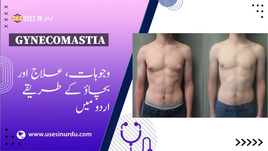 Gynecomastia