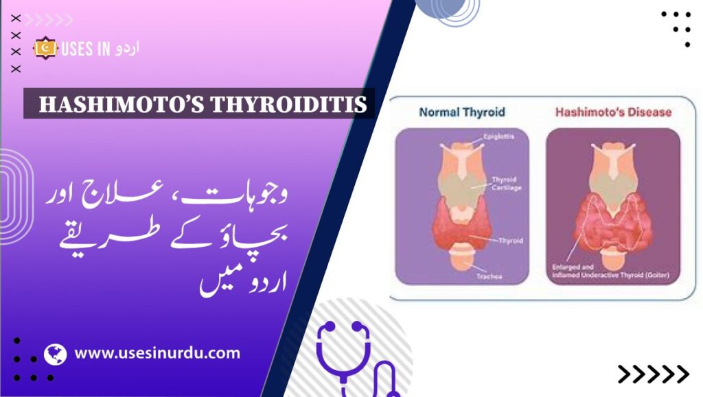 Hashimoto’s Thyroiditis