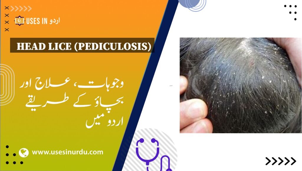 Head Lice (Pediculosis)