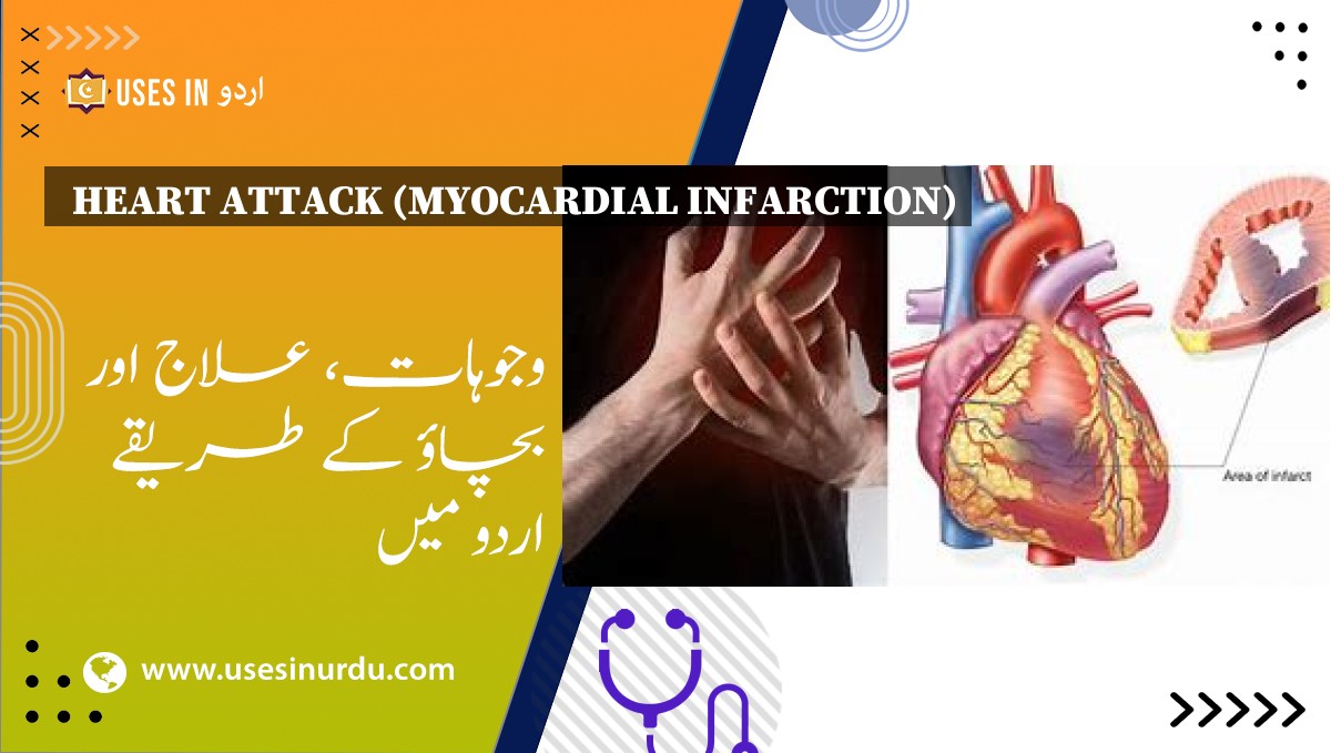 Heart Attack (Myocardial Infarction)