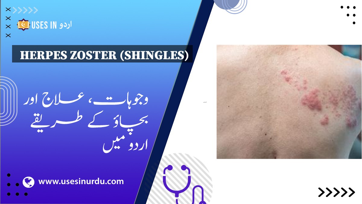 Herpes Zoster (Shingles)