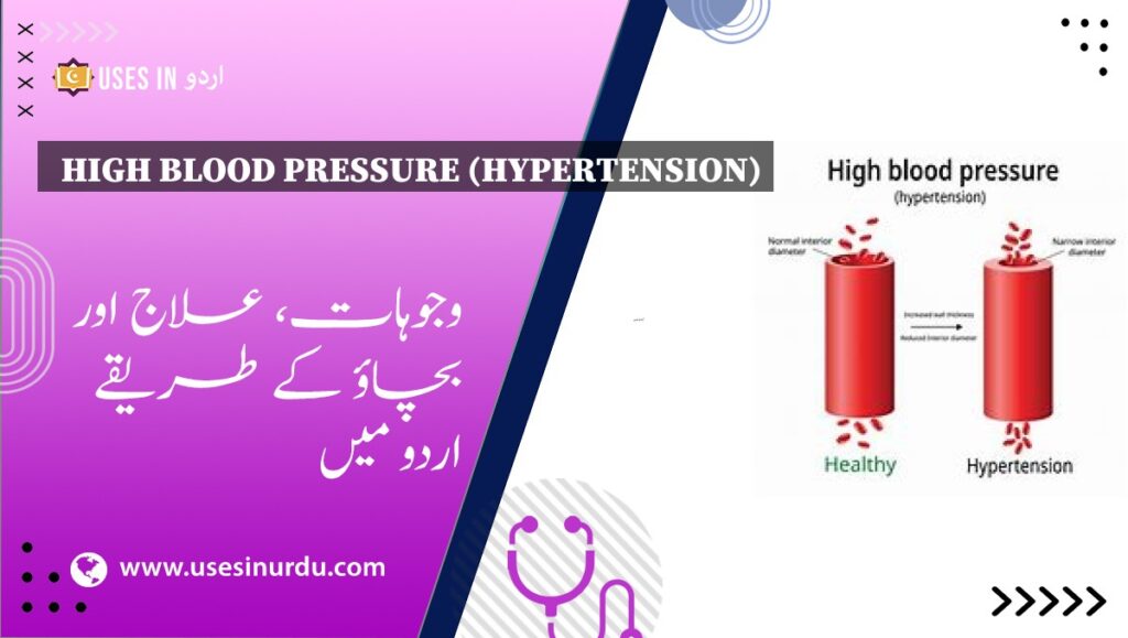 High Blood Pressure (Hypertension)