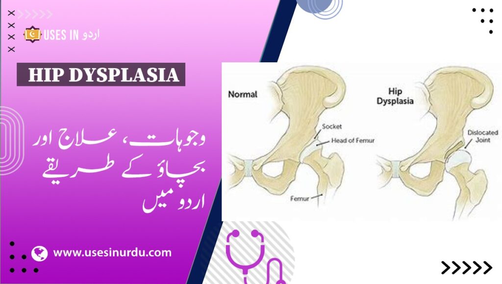 Hip Dysplasia