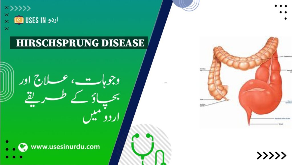 Hirschsprung Disease