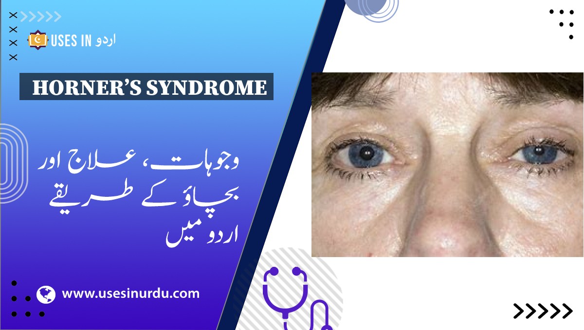 Horner’s Syndrome