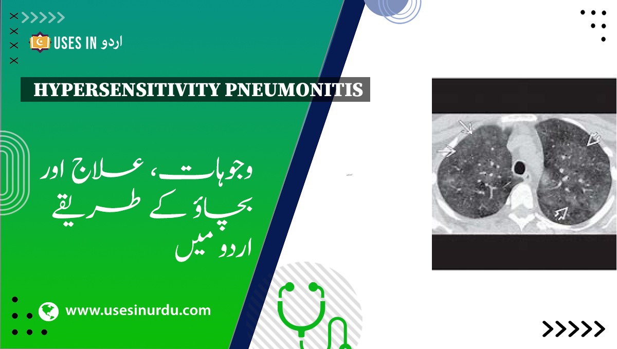 Hypersensitivity Pneumonitis