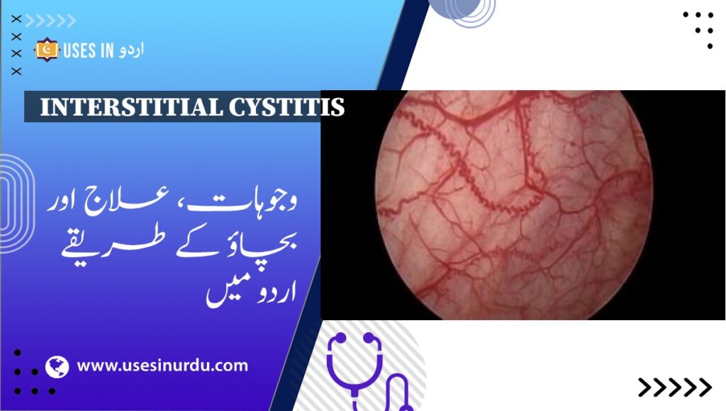 Interstitial Cystitis