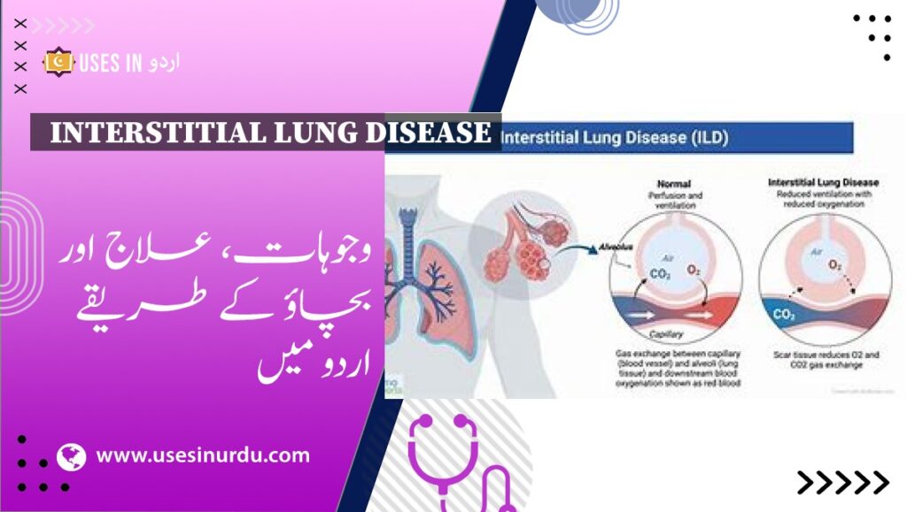 Interstitial Lung Disease