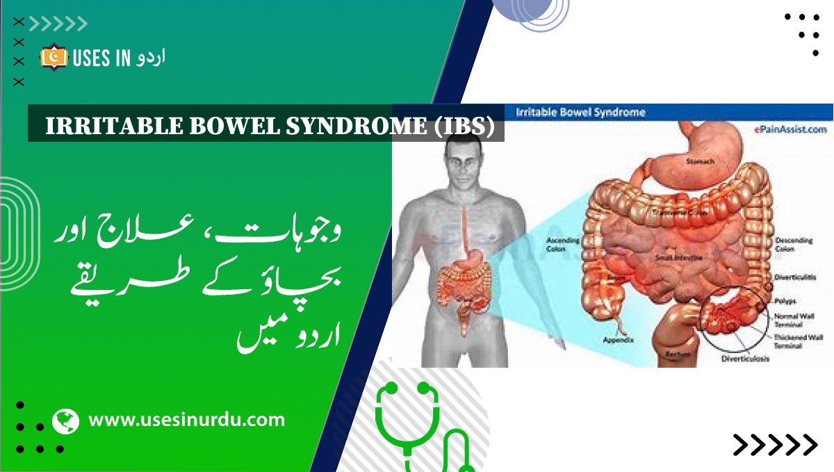 Irritable Bowel Syndrome (IBS)