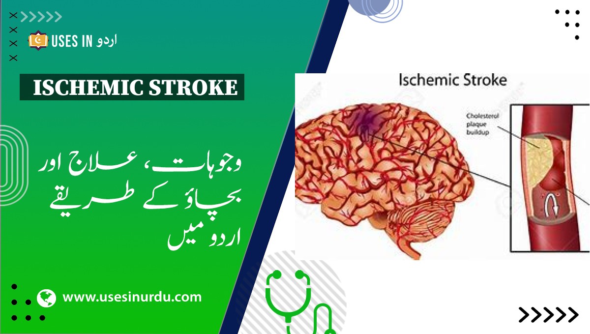 Ischemic Stroke