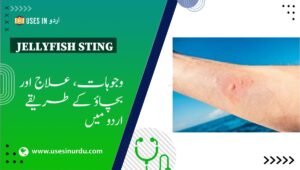 Jellyfish Sting
