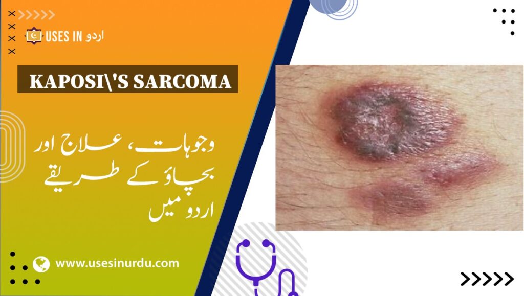 Kaposi's Sarcoma