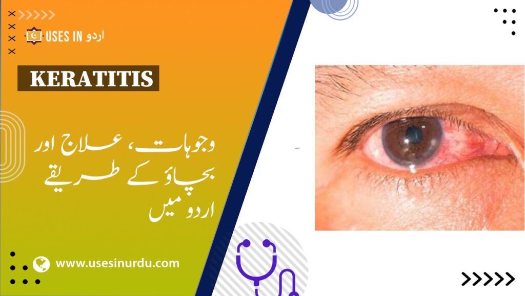 Keratitis