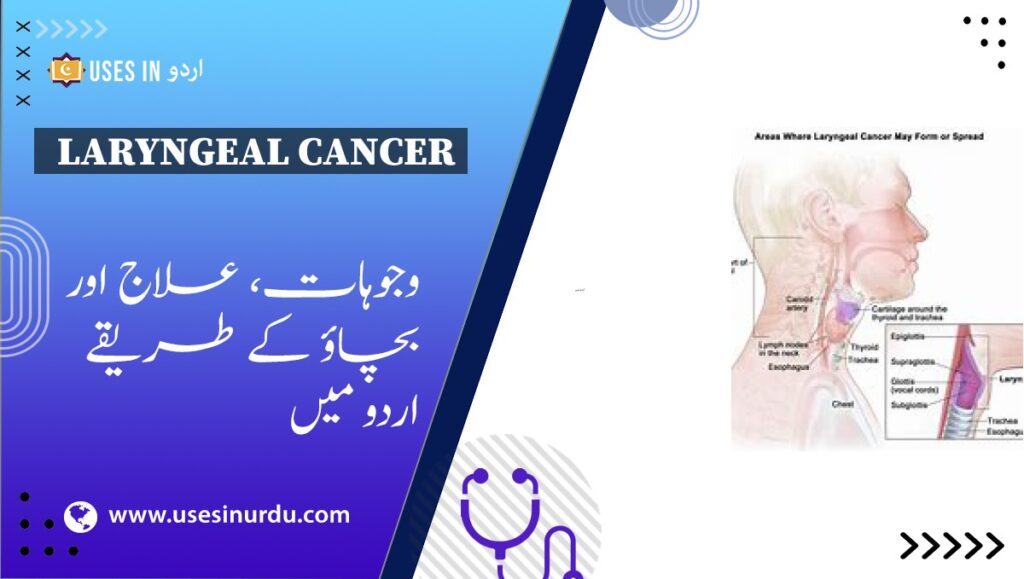 Laryngeal Cancer