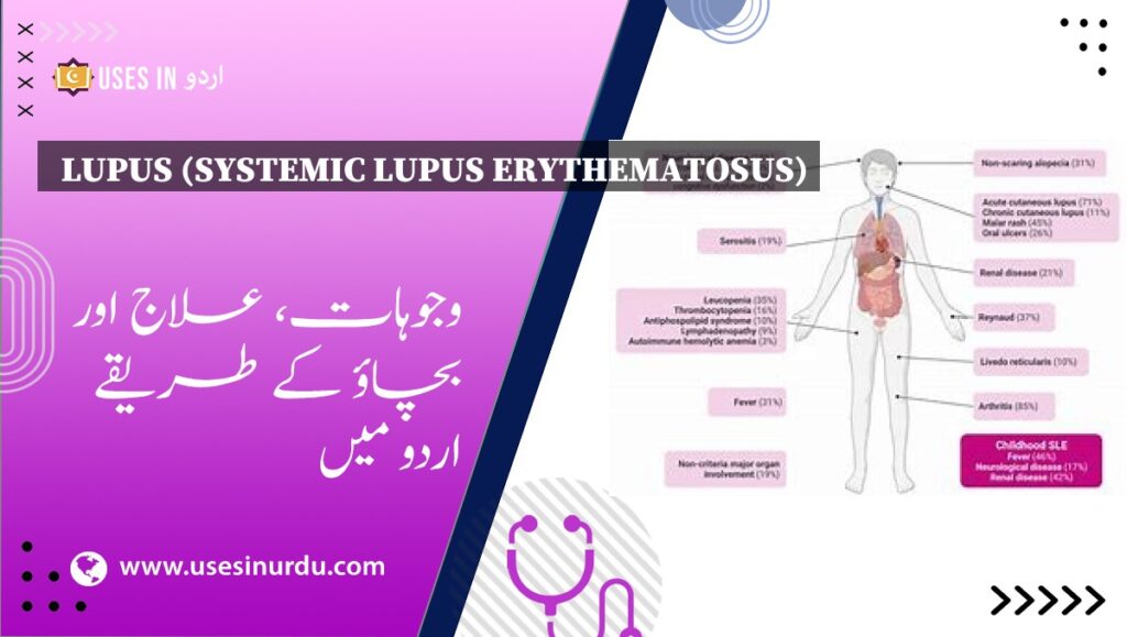 Lupus (Systemic Lupus Erythematosus)