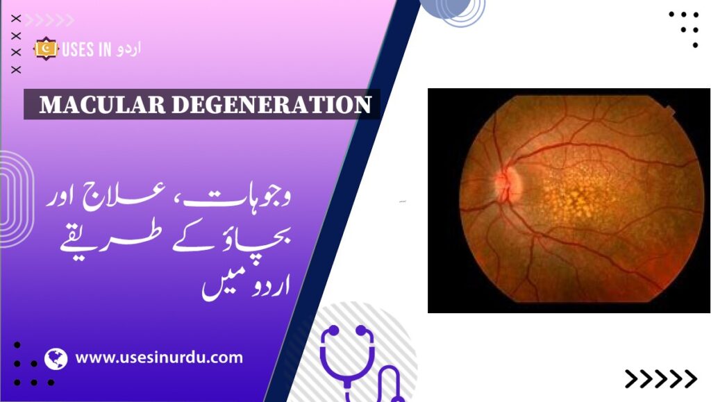 Macular Degeneration