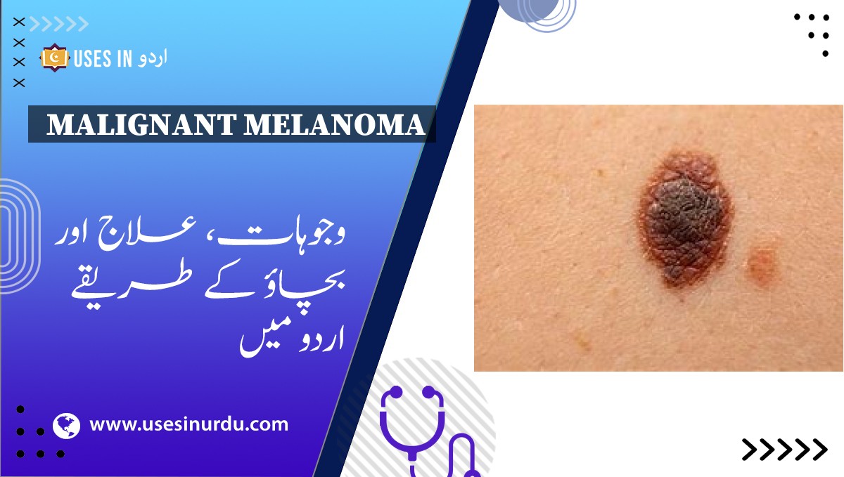 Malignant Melanoma