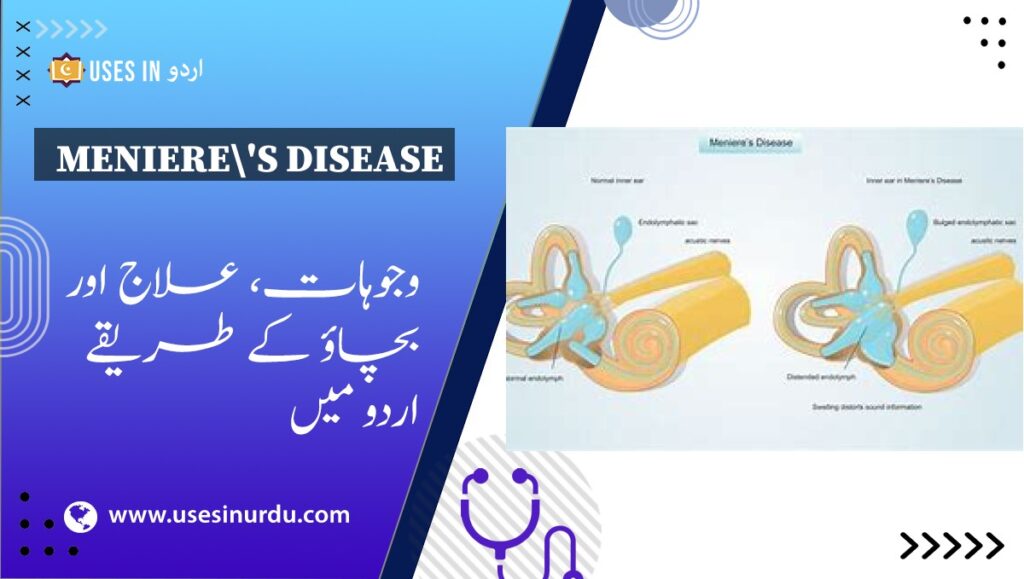 Meniere's Disease